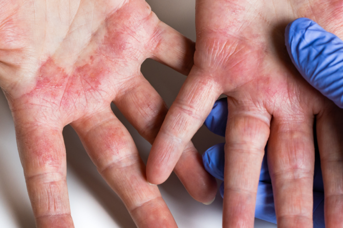 Understanding Dermatitis: Types, Symptoms, & Treatment