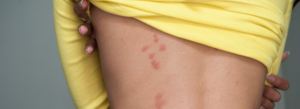 Bed Bugs: Identification, Prevention, and Treatment