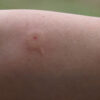 Insect Bites and Stings: Symptoms and Treatment