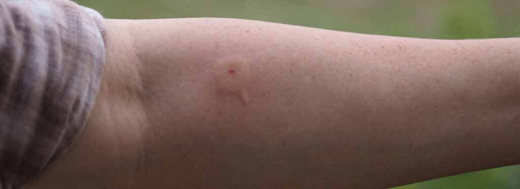 Insect Bites and Stings: Symptoms and Treatment