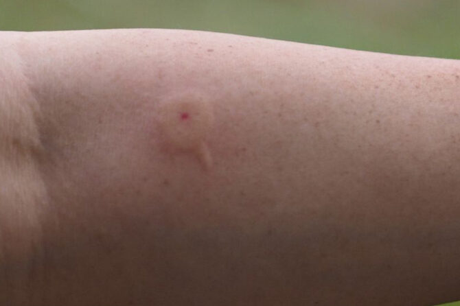 Insect Bites and Stings: Symptoms and Treatment