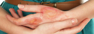 How to Treat a Minor Burn at Home