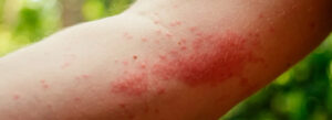 How To Treat Bug Bites and Stings