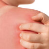 Urgent Care Sunburn Treatment: When to Seek Help